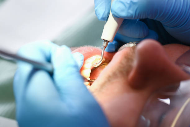 Best Emergency Root Canal Treatment in Sheldon, TX